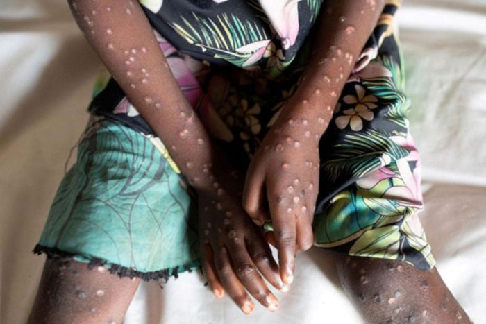 Uganda Confirms Two New Mpox Cases in Kasese: Regional Alert Issued